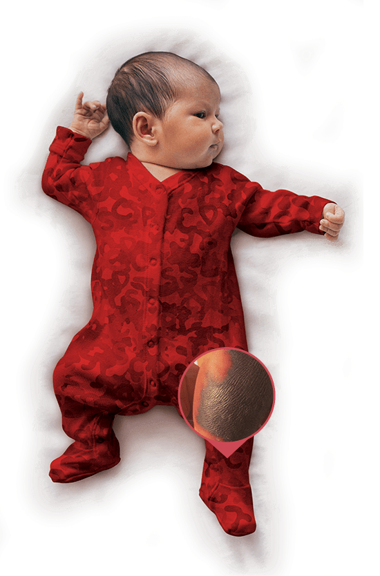 SCPCD – home Severe Congenital Protein C Deficiency