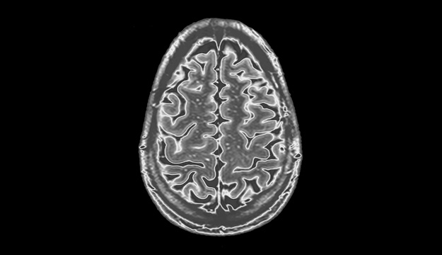 Severe Congenital Protein C Deficiency (SCPCD) symptom – cerebral venous thrombosis