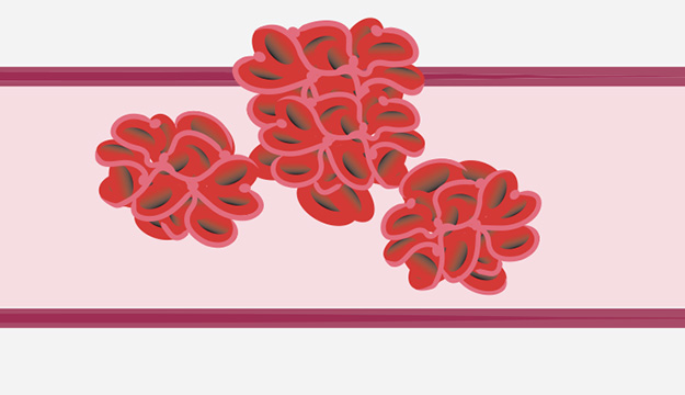 Severe Congenital Protein C Deficiency (SCPCD) symptom – venous thrombosis