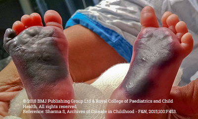 Severe Congenital Protein C Deficiency (SCPCD) purpura fulminans skin lesions