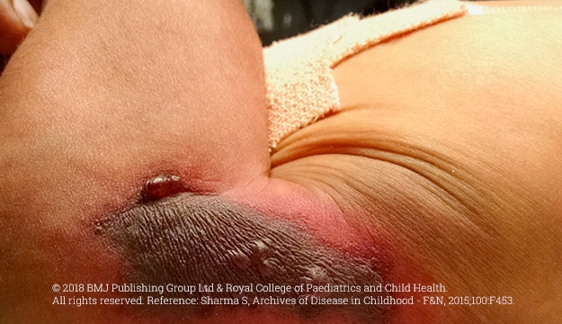 Severe Congenital Protein C Deficiency (SCPCD) symptom - purpura fulminans skin lesions