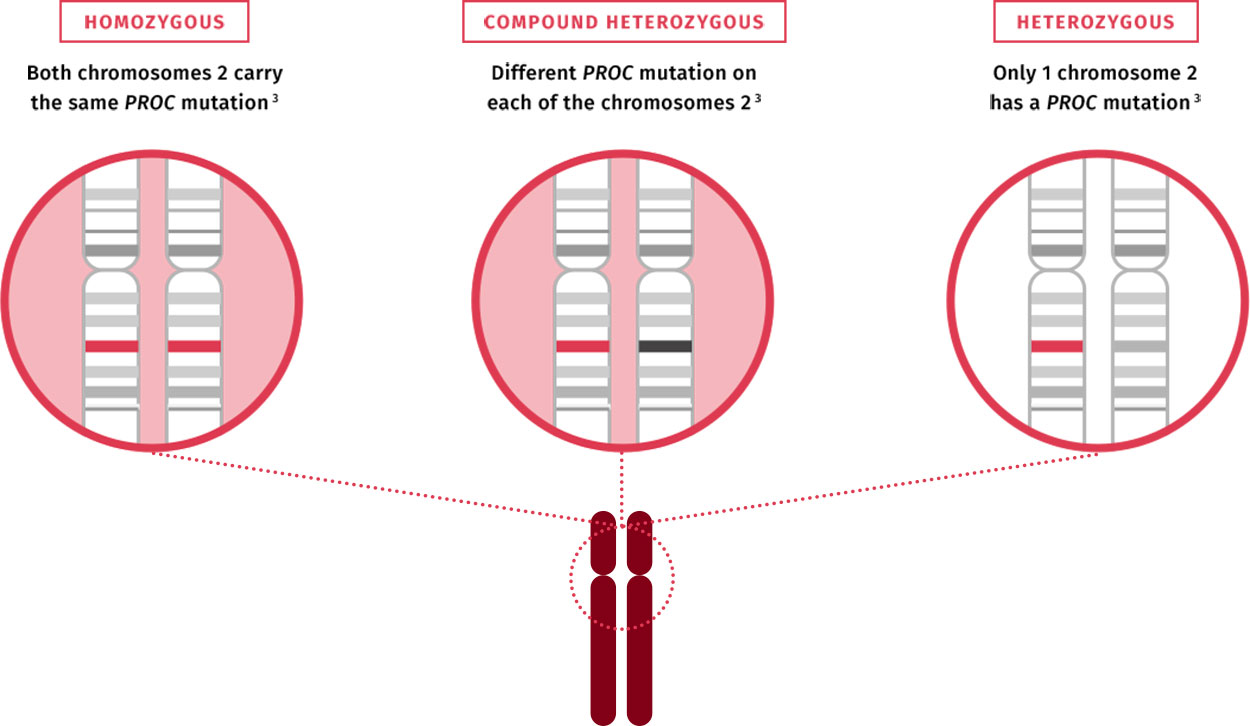 SCPCD - inheritance due to homozygous and compound heterozygous mutations in the PROC gene